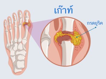 โรคเก๊าท์